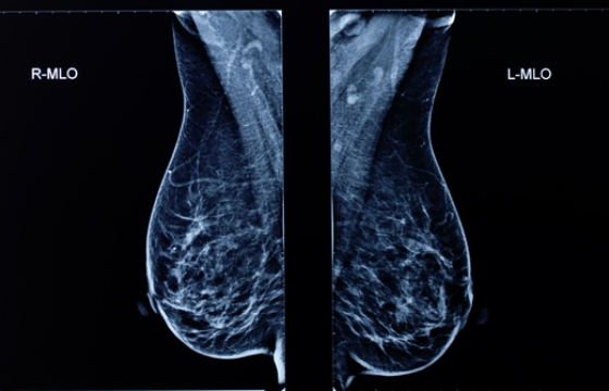유방촬영검사(Mammography)